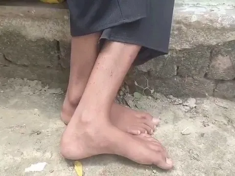 Bé gái lớp 9 bị rắn cắn 9 lần trong 40 ngày: Ám ảnh sợ hãi về con rắn lớn "khủng khiếp"