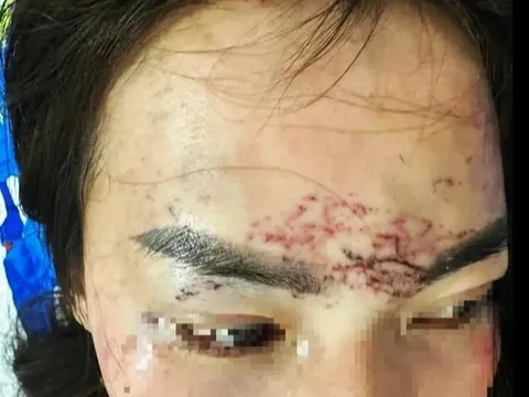 Vụ 2 phụ nữ đánh ghen, đổ axit, xăm mặt người khác ở Cà Mau có diễn biến mới