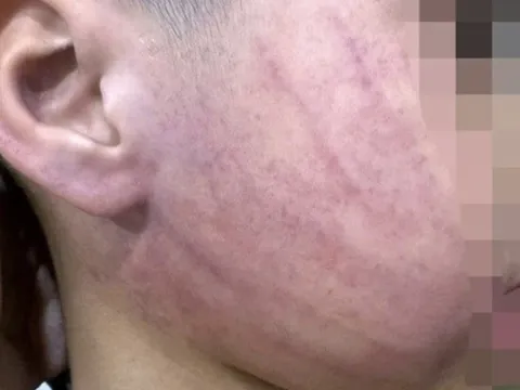 Vụ bé 4 tuổi nghi bị giáo viên mầm non đánh bầm tím mặt ở Hà Nội: Giáo viên phụ trách nói gì?