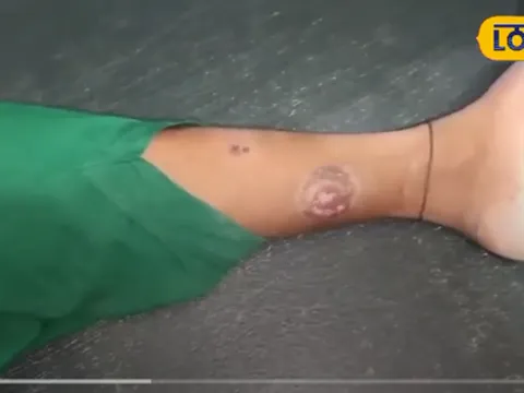 Cô gái trẻ sống sót kỳ diệu sau 41 lần bị rắn cắn, điều gì đã xảy ra?