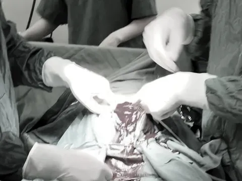 Tự phá thai 33 tuần, thai phụ bị vỡ tử cung 3 lít máu tràn ổ bụng: Tiết lộ điều đặc biệt trong ca mổ xuyên đêm giành sự sống từ tay "tử thần" cho bệnh nhân