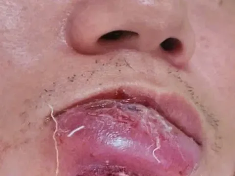 Tưởng chỉ là mụn mép môi vô hại, nhưng vài ngày sau người đàn ông gánh hậu quả nặng nề