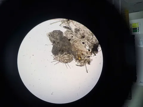 Mi mắt ngứa ngáy, đi khám mới tá hoả phát hiện cả đàn rận trú ngụ bên trong