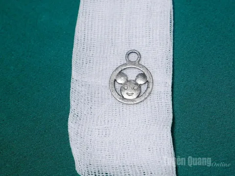 Hoảng hồn: Cứu bé trai 5 tuổi vô tình nuốt móc cặp sách vào bụng