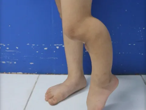 Khoét bột để đắp lá cho con khi đã được bó bột, bố mẹ khiến con gái không thể liền xương