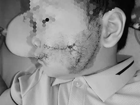 Thương tâm: Đang chơi trong sân nhà, bé trai 5 tuổi bất ngờ bị chó lao vào tấn công cắn rách mặt