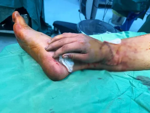 Bàn tay đứt lìa của thai phụ bị tai nạn được ghép tạm vào chân chờ ngày nối lại: Kỳ tích của "từ mẫu" hiện thực hóa ước mơ "được chăm sóc con bằng đôi tay của mình"