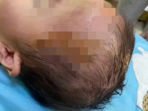 Bé gái 19 tháng tuổi đang chơi ngoài đường bất ngờ bị chó dữ tấn công, thương tích nghiêm trọng vùng mặt, đầu và cổ