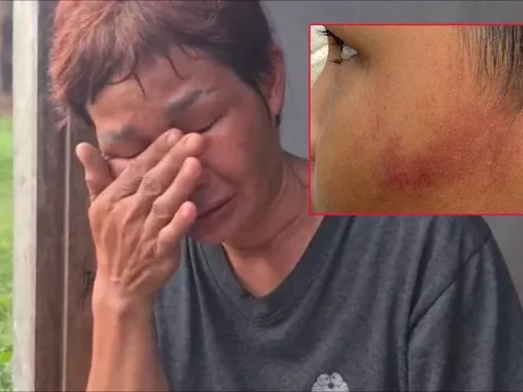 Cô giáo dùng thước sắt đánh tới tấp 14 nhát vào mặt học sinh 7 tuổi chỉ vì ăn một viên kẹo