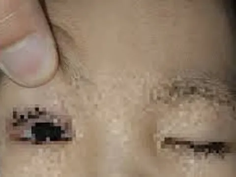 Bé 2 tuổi ở Ninh Bình bị pháo hoa bắn trúng mắt khi xem Trung thu – Cảnh báo đáng lo ngại