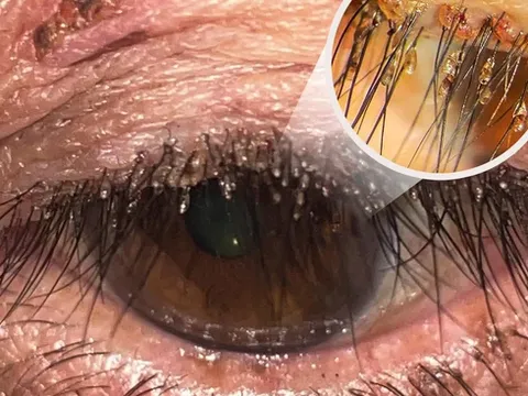 Ngứa, cộm mắt kéo dài, người phụ nữ đi khám mới biết rận mu bám chi chít trên lông mi