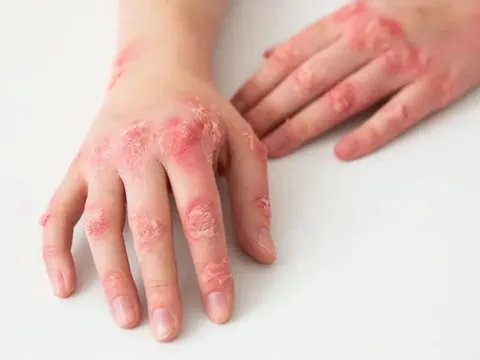 Con nổi nốt đỏ ở lòng bàn tay, bác sĩ nói một câu khiến người mẹ chết lặng