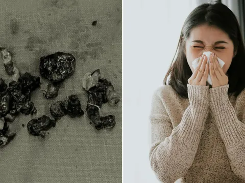 Liên tục ngửi thấy mùi hôi, người phụ nữ giật mình khi phát hiện thứ kỳ lạ này trong mũi