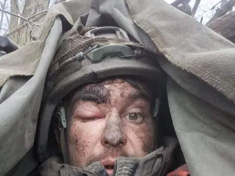 Mặc kệ viên đạn mắc kẹt trong não, người lính Nga vẫn kiên cường chiến đấu suốt cả tuần