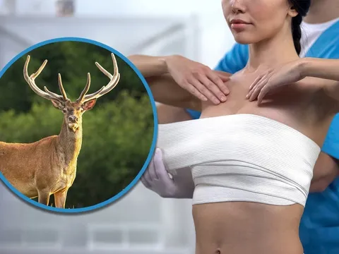 Người phụ nữ "tiền mất, tật mang" sau khi cấy ghép ngực chứa ADN gia súc