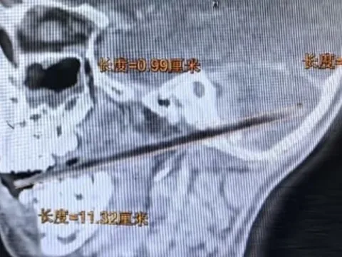 Vừa ăn vừa chạy nhảy, bé trai Trung Quốc bị que kẹo 11cm đâm xuyên từ miệng lên não