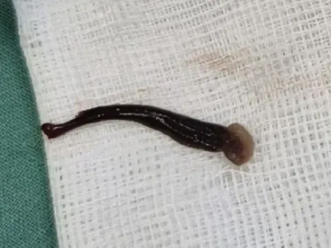 Bé gái chảy máu cam suốt 4 ngày, bác sĩ choáng váng khi phát hiện “thủ phạm” sống trong mũi