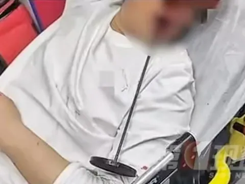 Nam thanh niên say rượu ngã vào thanh sắt, bị đâm xuyên từ miệng lên đầu: Ca phẫu thuật nghẹt thở kéo dài 10 tiếng