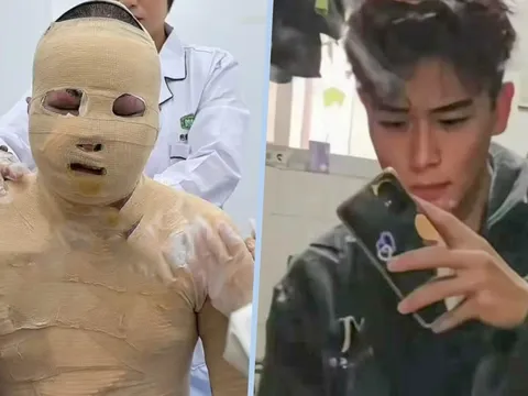 Nam sinh bỏng 90%, bị bạn cùng phòng khóa cửa, bỏ mặc trong biển lửa