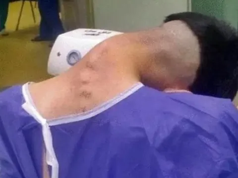 Chàng trai 23 tuổi mắc hội chứng “gục đầu”, cổ cong 90 độ sau nhiều năm nghiện ma túy