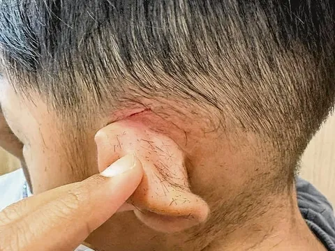 Bé 3 tuổi khóc thét vì bị thợ cắt vào tai, salon thờ ơ, bố mẹ giận dữ đòi kiện