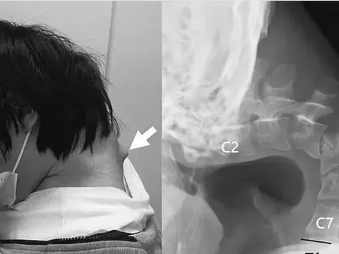 Ngẩng đầu không nổi vì chơi điện thoại quá nhiều, nam thanh niên gặp biến chứng nghiêm trọng