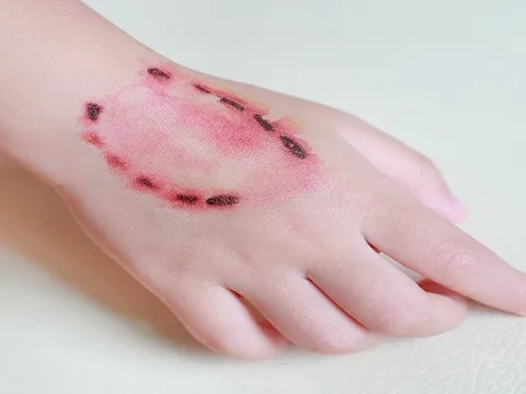 Cắn người như zombie ở Singapore: Nạn nhân bị xé rách tay, phải ghép da để cứu chữa