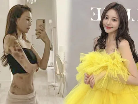 Nữ người mẫu thắng kiện phòng khám sau 4 năm bị hủy hoại sức khỏe, phơi bày mặt tối ngành thẩm mỹ
