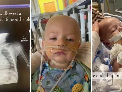 Bé trai suýt tử vong vì nuốt phải pin, cần phẫu thuật tới 29 lần