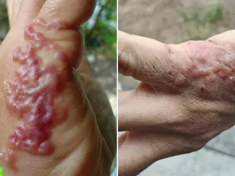 Cô gái ngứa rát cả đêm, chết lặng khi phát hiện giun móc bò dưới da