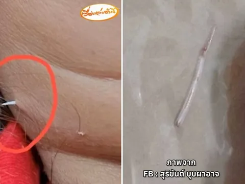 Cảnh báo sau vụ xương cá đâm xuyên cổ: Đừng cố nuốt thêm cơm khi hóc xương