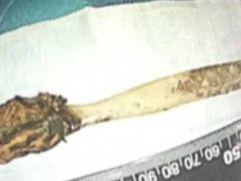 Bác sĩ phát hiện chiếc bàn chải mắc kẹt trong ruột người đàn ông suốt 5 thập kỷ