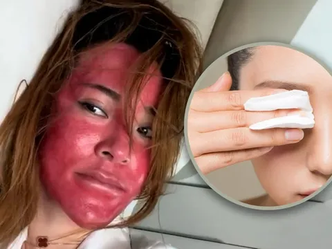 Không tẩy trang suốt 22 năm, người phụ nữ nhận hậu quả đau đớn