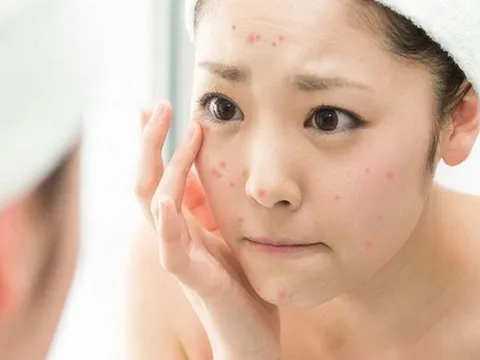 Nữ sinh 15 tuổi tử vong sau khi tự nặn mụn: Hồi chuông cảnh báo từ thói quen tưởng chừng vô hại