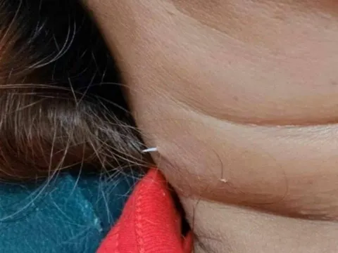 Tưởng viêm họng, đi khám thì bác sĩ tái mặt khi thấy dị vật xuyên ra từ cổ bệnh nhân