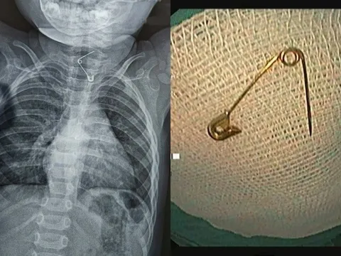 Bé 12 tháng tuổi nhập viện vì bị kim băng ghim thẳng vào thực quản: Bác sĩ cảnh báo 1 sai lầm nhiều cha mẹ mắc phải