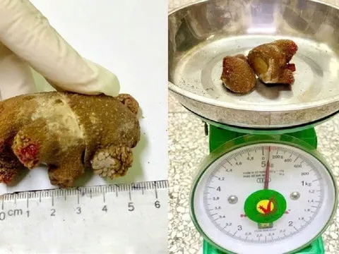 Bác sĩ bàng hoàng khi gắp ra viên sỏi như mảnh san hô nằm trong cơ thể người đàn ông suốt 20 năm
