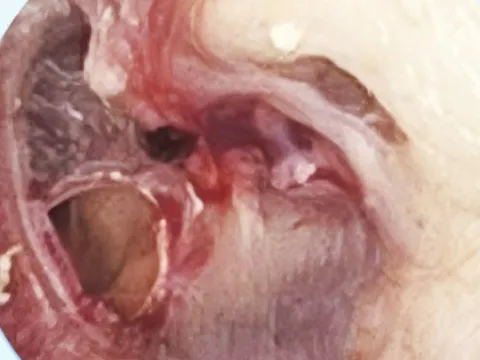 "Báo con" vô tình khiến mẹ thủng màng nhĩ, nhập viện gấp chỉ vì trò chơi quen thuộc của biết bao đứa trẻ