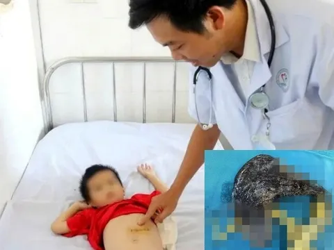 Bé trai 5 tuổi nhập viện vì đau bụng, bác sĩ sững sờ khi phát hiện dị vật này