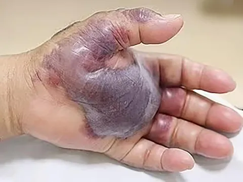 Bác sĩ cảnh báo về loại vi khuẩn “ăn thịt người” ở biển có thể gây tử vong trong 48 giờ