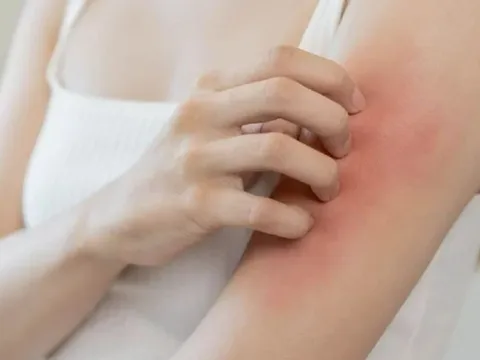 Đừng đổ lỗi cho “gan nóng” nếu bạn đang ngứa âm ỉ mỗi ngày