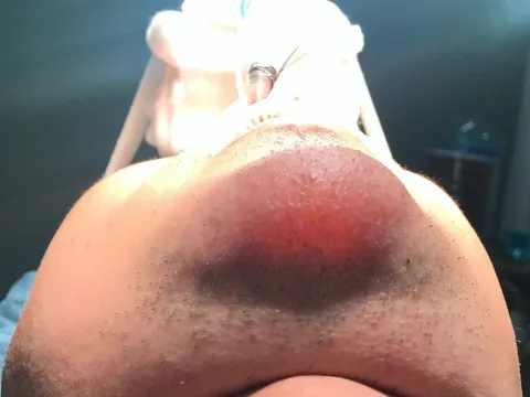 Chàng trai tá hỏa khi thấy chiếc cằm sưng tấy, "phát sáng" bất thường chỉ vì phương pháp làm đẹp này