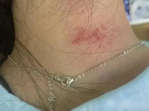 Mua vòng cổ lấp lánh giá chưa đến 700 nghìn trên livestream, người phụ nữ nhận “cái kết” viêm da phồng rộp, kiểm nghiệm phát hiện kim loại độc vượt ngưỡng sốc gấp 1.179 lần