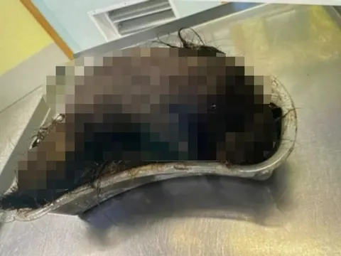 Bé gái đau bụng suốt 6 tháng, bác sĩ phẫu thuật lấy ra "búi tóc" khổng lồ gần 1 kg trong dạ dày