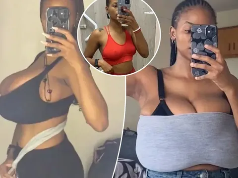 “Ngực to” không phải lúc nào cũng là mơ ước: Vòng 1 “phẳng lì” bỗng hóa “khổng lồ” chỉ sau vài tháng, cô gái trẻ sốc nặng khi biết mình mắc bệnh hiếm gặp