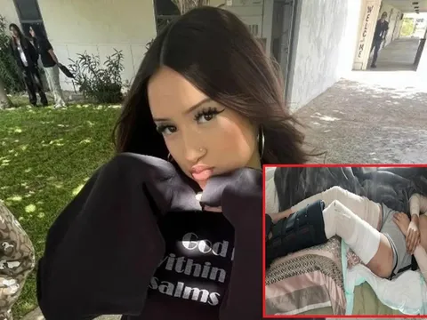 Kinh hoàng nữ sinh 17 tuổi bị cả đàn chó lao vào cắn xé đến mức mẹ không thể nhận ra, phải khâu hơn 500 mũi khắp người