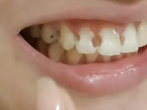 Cô gái 20 tuổi niềng răng 5 năm, tháo niềng xong khóc ngất vì phát hiện 8 chiếc răng thủng lỗ, hỏng nặng