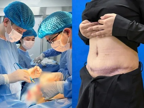 Hút mỡ, cô gái 25 tuổi bị biến dạng bụng, gây hoại tử trắng: Bác sĩ cảnh báo điều này