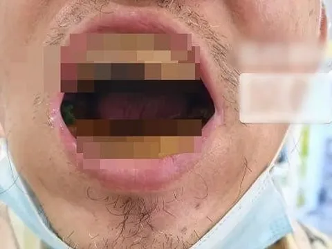 Ham tiết kiệm, người đàn ông tự làm răng giả và kết cục khiến ai nhìn cũng rùng mình