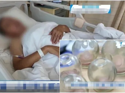 Người đàn ông liệt nửa người sau khi giác hơi tại nhà: Bác sĩ cảnh báo điều này